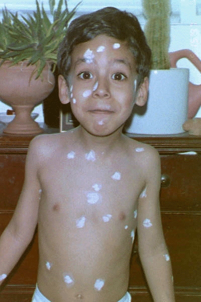 Nevin with pox